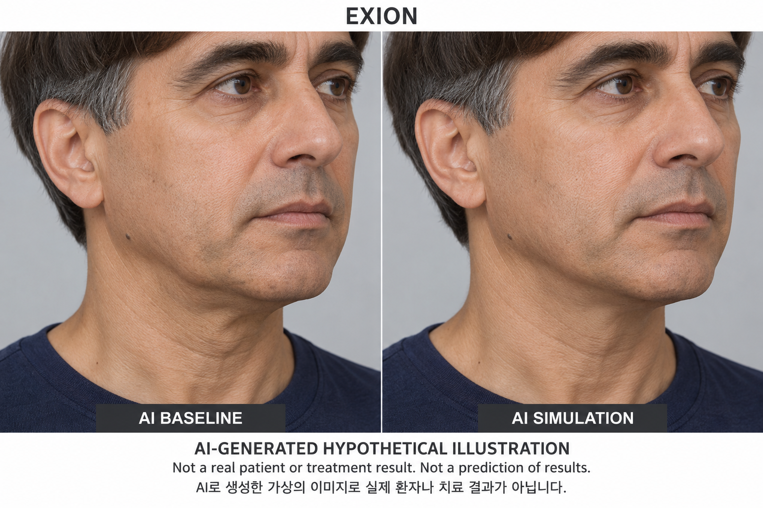 虛構AI示例,並非真實患者、治療結果或結果預測 — EXION 電波平台