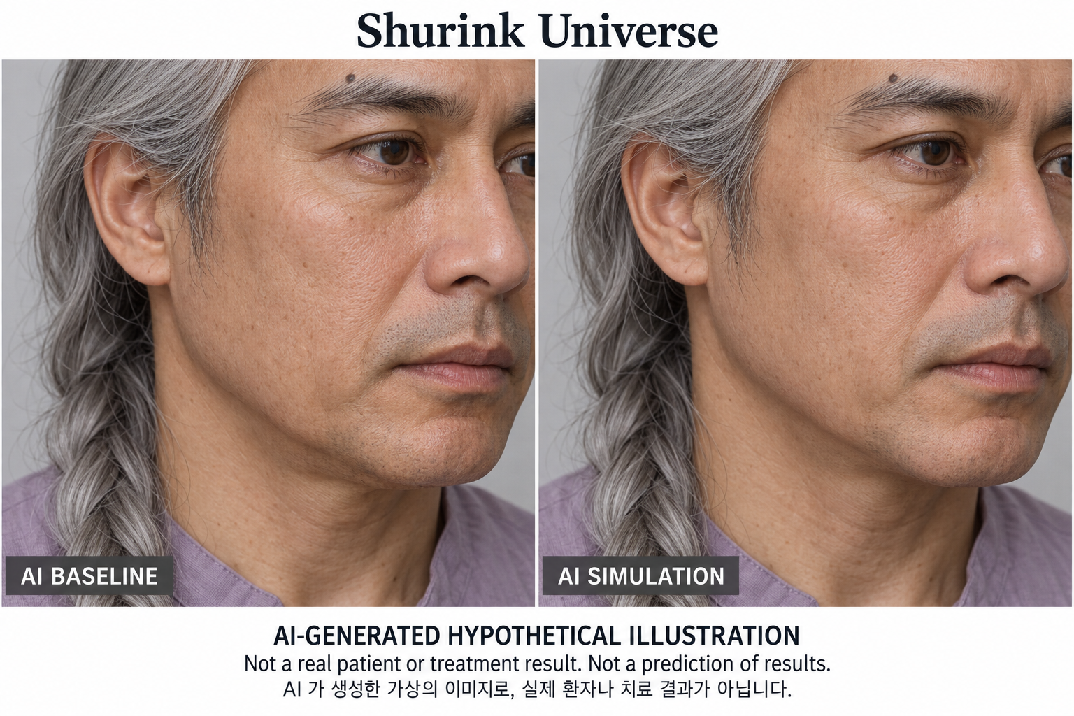 虛構AI示例，並非真實患者、治療結果或結果預測 — Shurink Universe 海芙音波