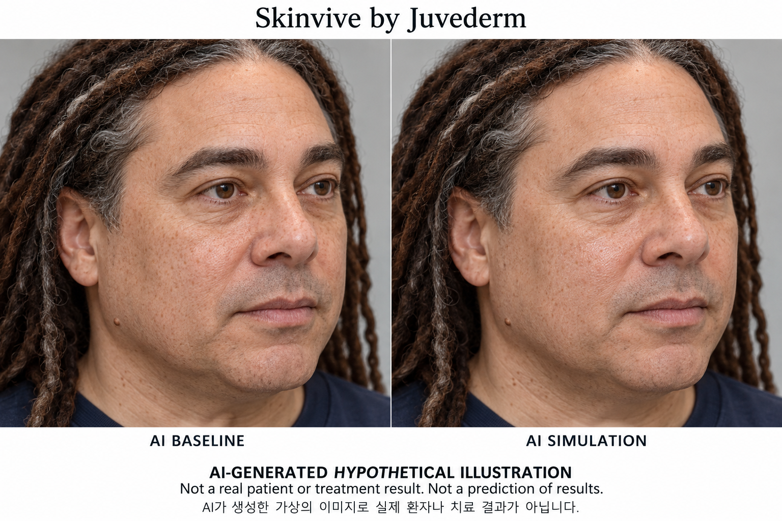 虛構AI示例，並非真實患者、治療結果或結果預測 — Juvéderm Skinvive